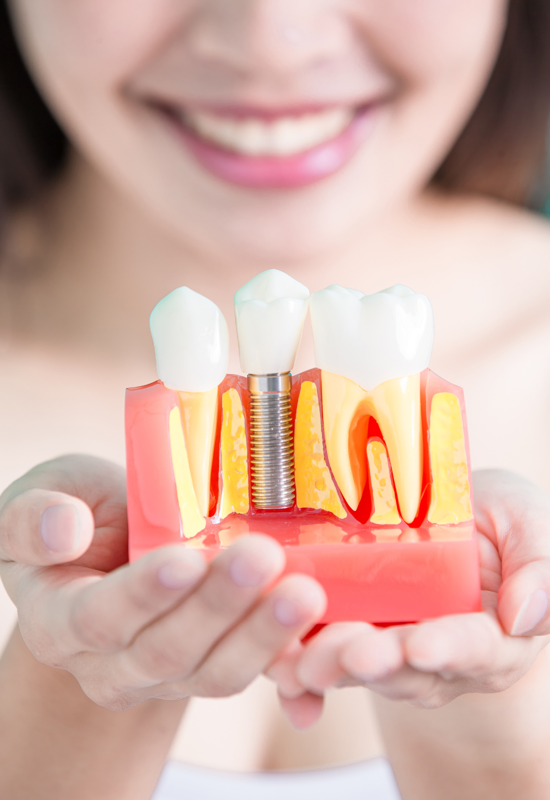 dental implants burnaby