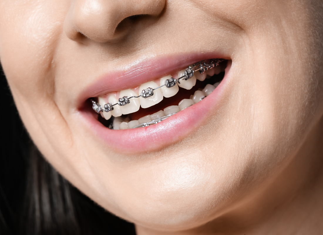 orthodontics burnaby