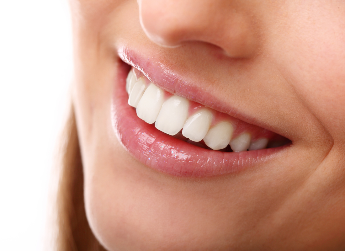 teeth whitening burnaby