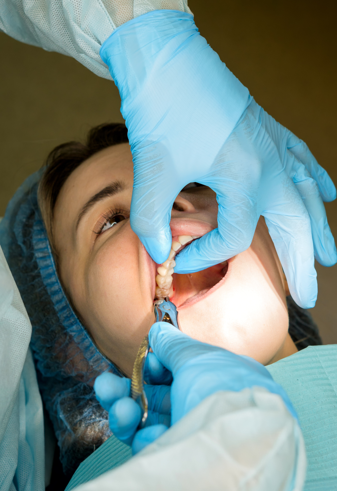 wisdom teeth extraction burnaby