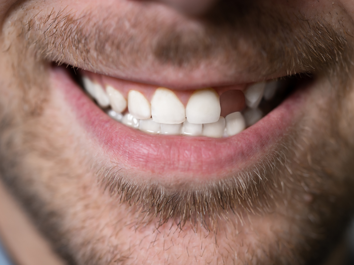 missing teeth dental implants burnaby